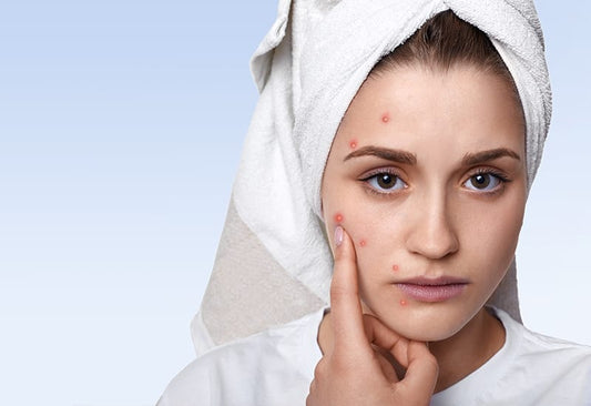 Home Remedies For Acne